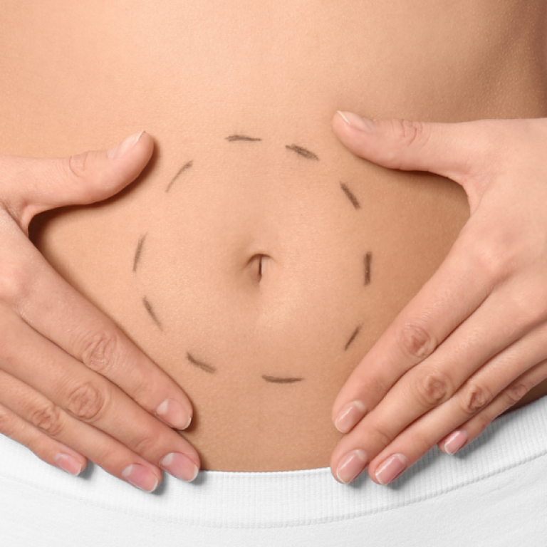 Tummy Tuck